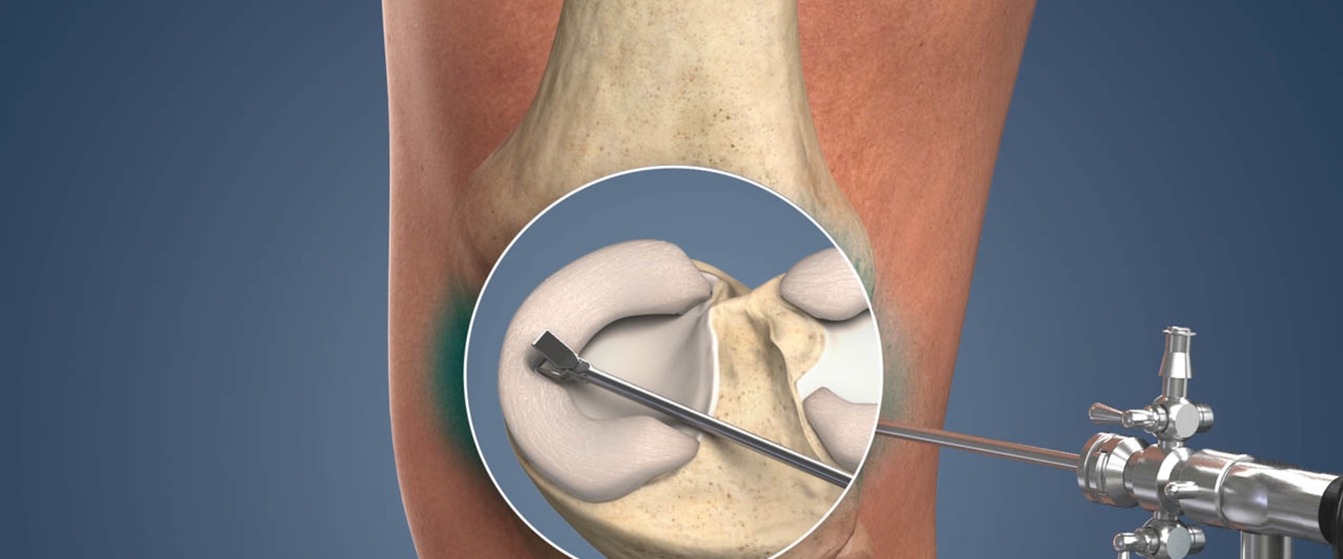 Understanding Arthroscopic Surgery for Knee Pain Relief