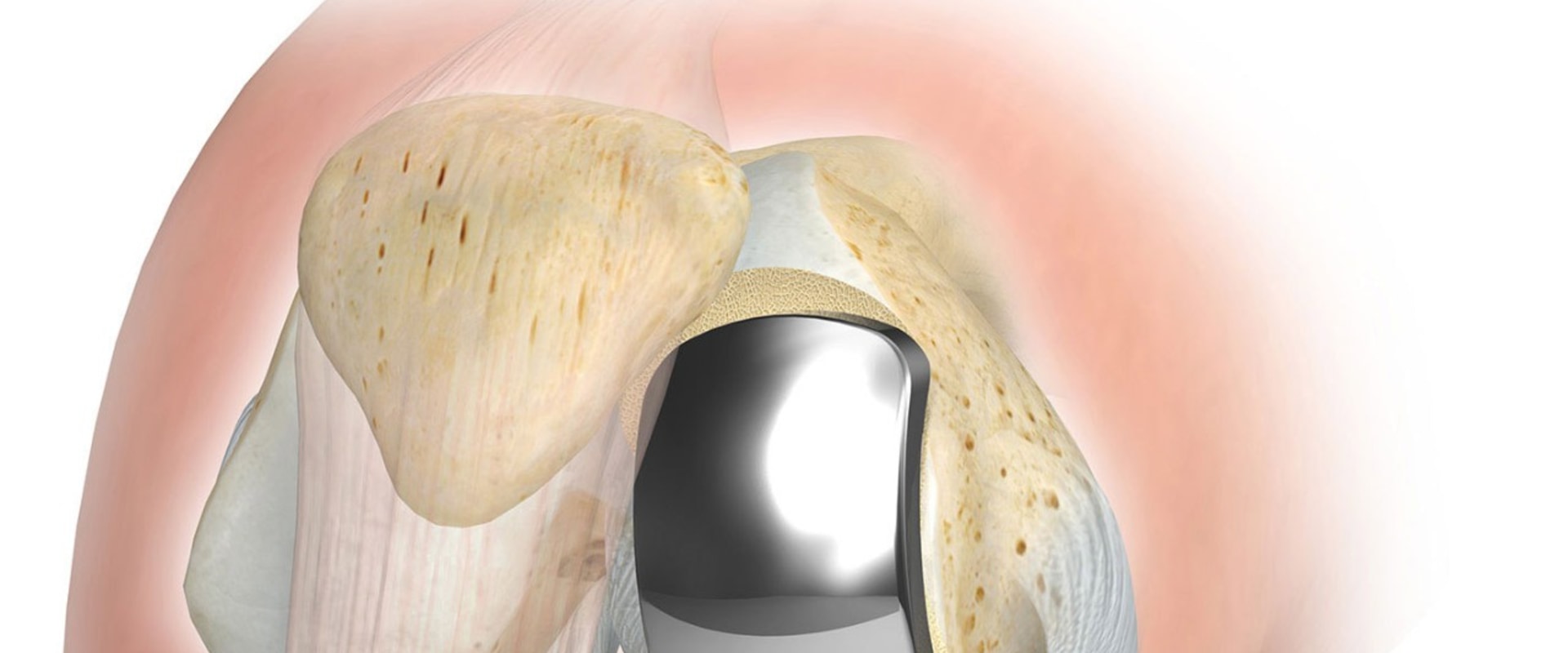 Knee Replacement Surgery: Understanding Treatment Options for Knee Pain