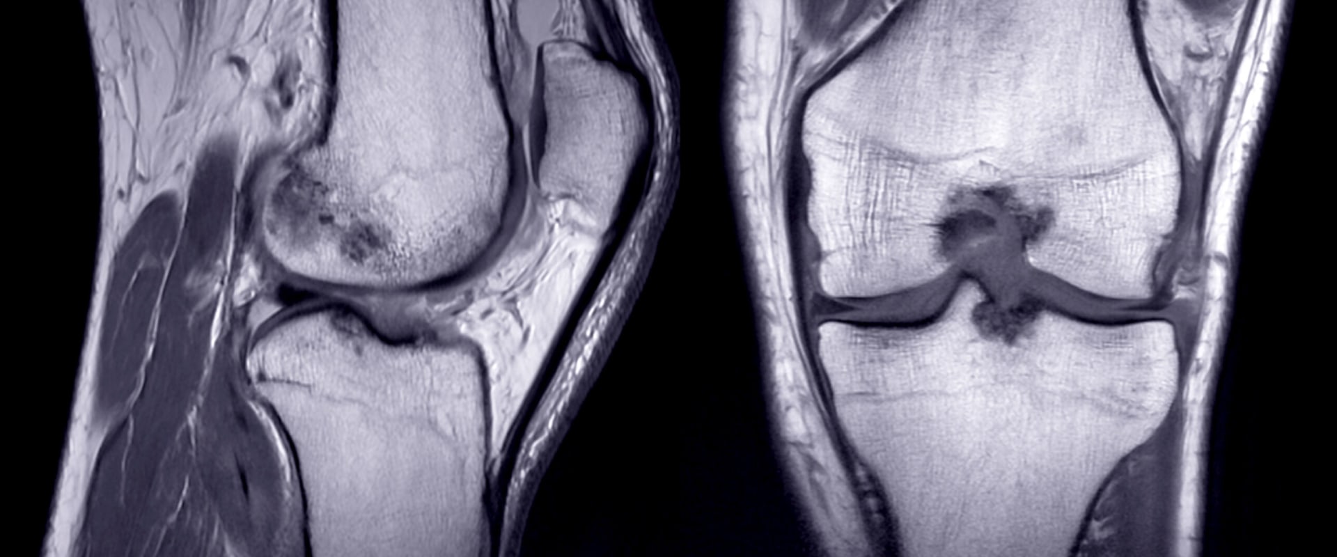 MRI for Chronic Knee Pain: Understanding Diagnosis and Management