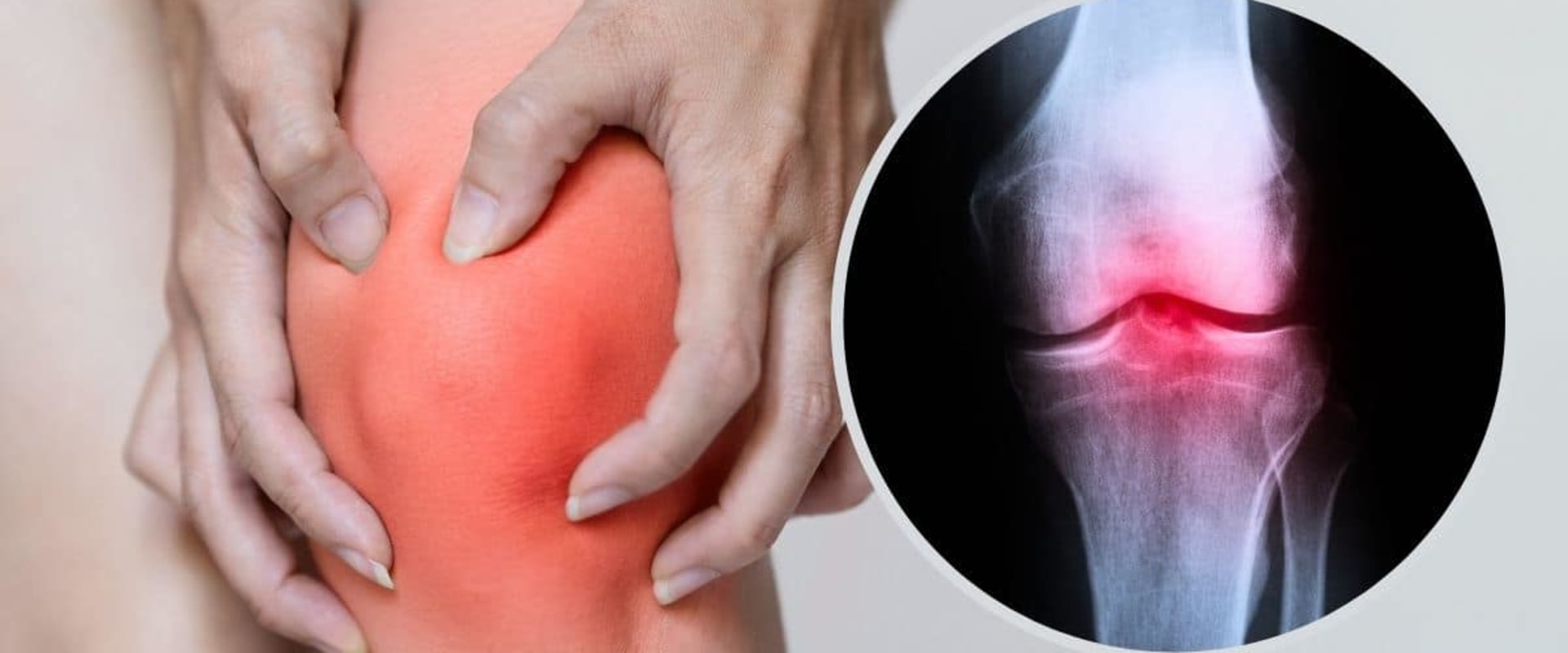 Understanding Rheumatoid Arthritis and Knee Pain