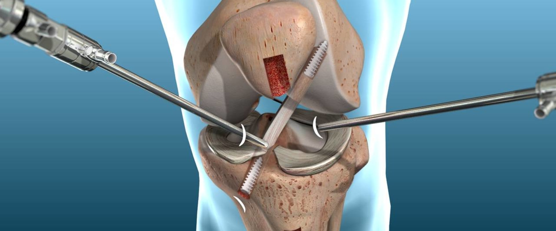 Understanding Ligament Reconstruction: A Comprehensive Guide