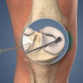 Understanding Arthroscopic Surgery for Knee Pain Relief