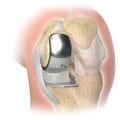 Knee Replacement Surgery: Understanding Treatment Options for Knee Pain