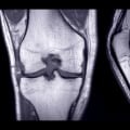 MRI for Chronic Knee Pain: Understanding Diagnosis and Management