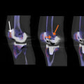 Understanding CT Scans for Knee Pain: Diagnosis and Management