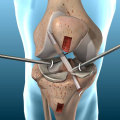 Understanding Ligament Reconstruction: A Comprehensive Guide