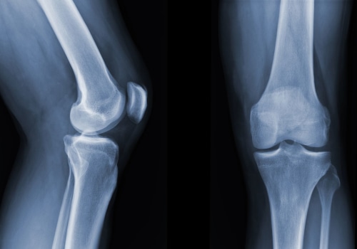 Understanding X-rays for Chronic Knee Pain Relief