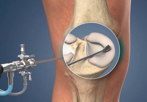 Understanding Arthroscopic Surgery for Knee Pain Relief