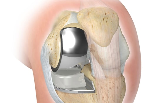 Knee Replacement Surgery: Understanding Treatment Options for Knee Pain