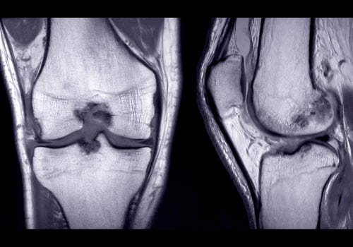 MRI for Chronic Knee Pain: Understanding Diagnosis and Management