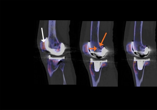 Understanding CT Scans for Knee Pain: Diagnosis and Management