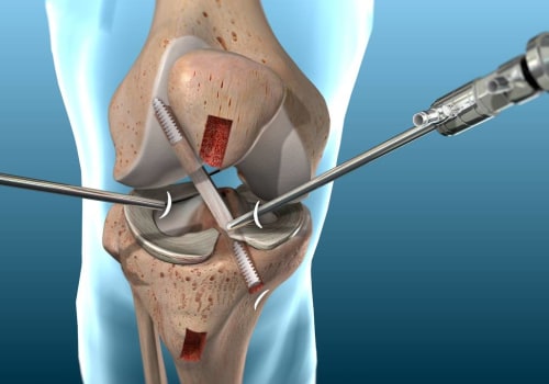 Understanding Ligament Reconstruction: A Comprehensive Guide